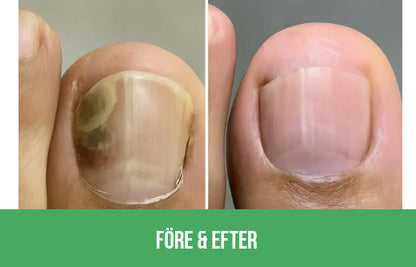 Nuvion Nagelförnyelse Plåster