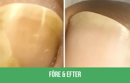 Nuvion Nagelförnyelse Plåster