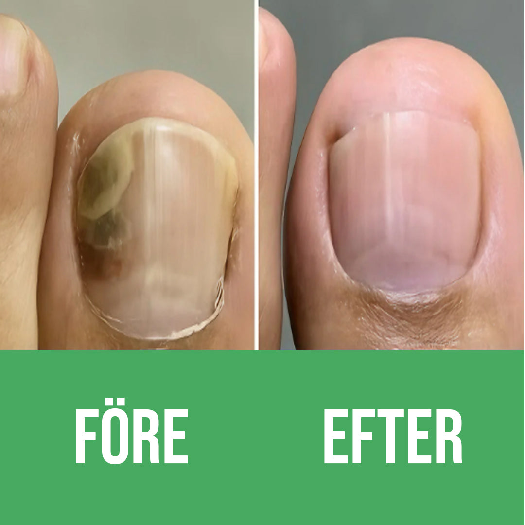 Nuvion Nagelförnyelse Plåster