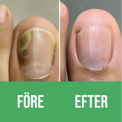 Nuvion Nagelförnyelse Plåster