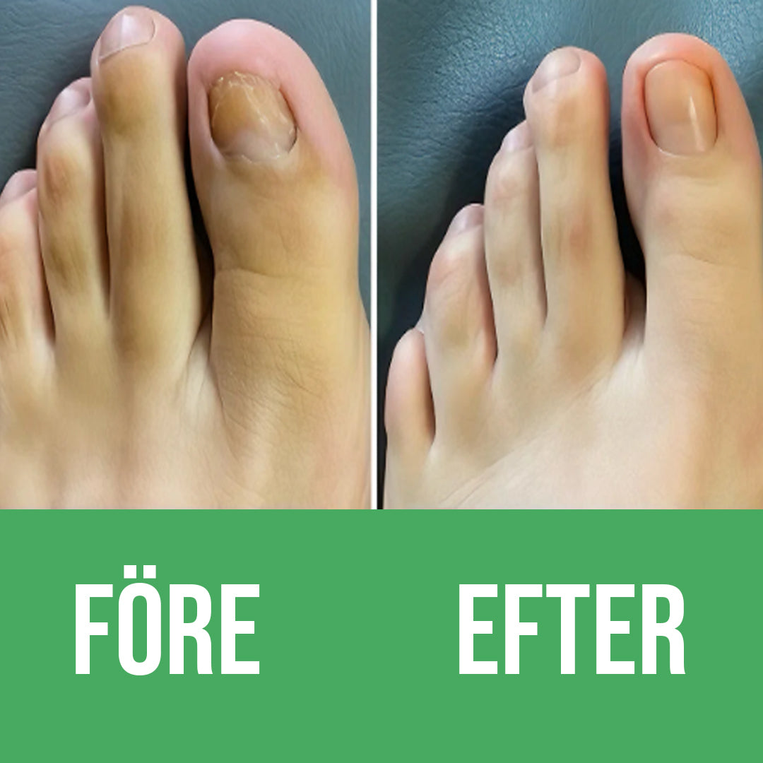 Nuvion Nagelförnyelse Plåster